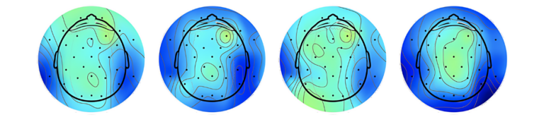 EEG Brain Topography showing Mistikist-induced coherent Alpha waves