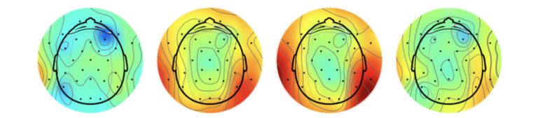 EEG Brain Topography showing stress-related high Beta activity